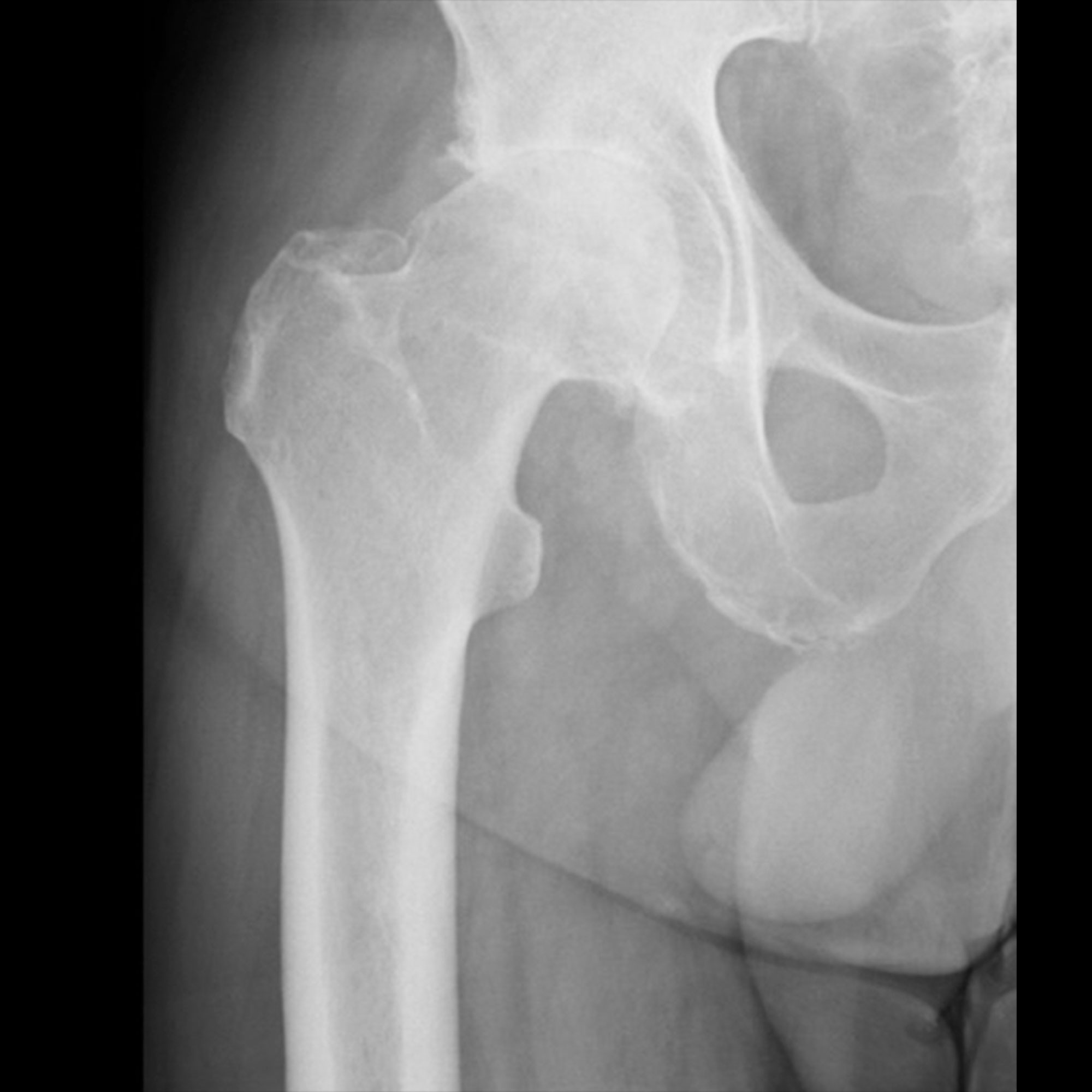 Radiografía con imagen de artrosis severa de cadera 