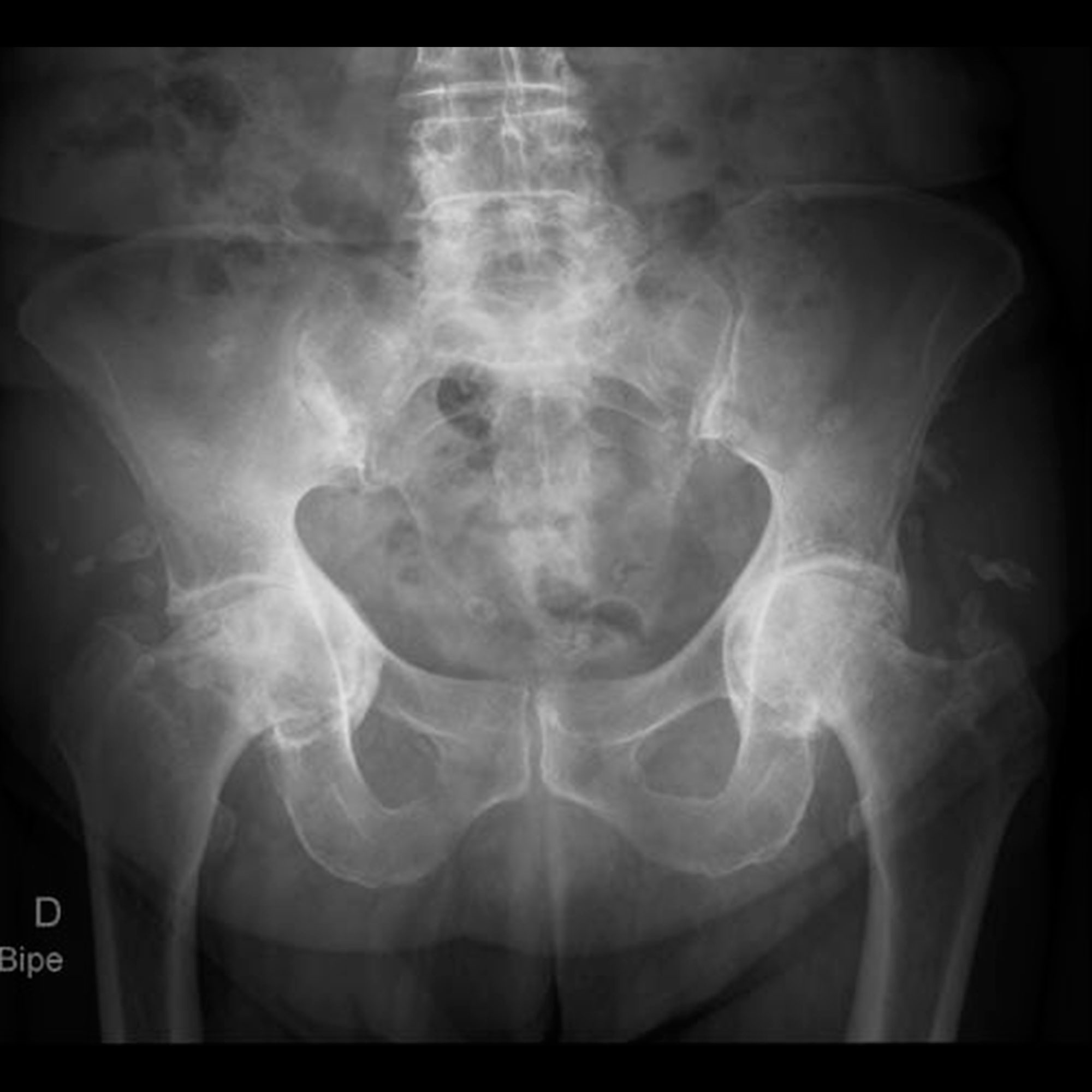 Radiografía con imagen de coxa protrusa