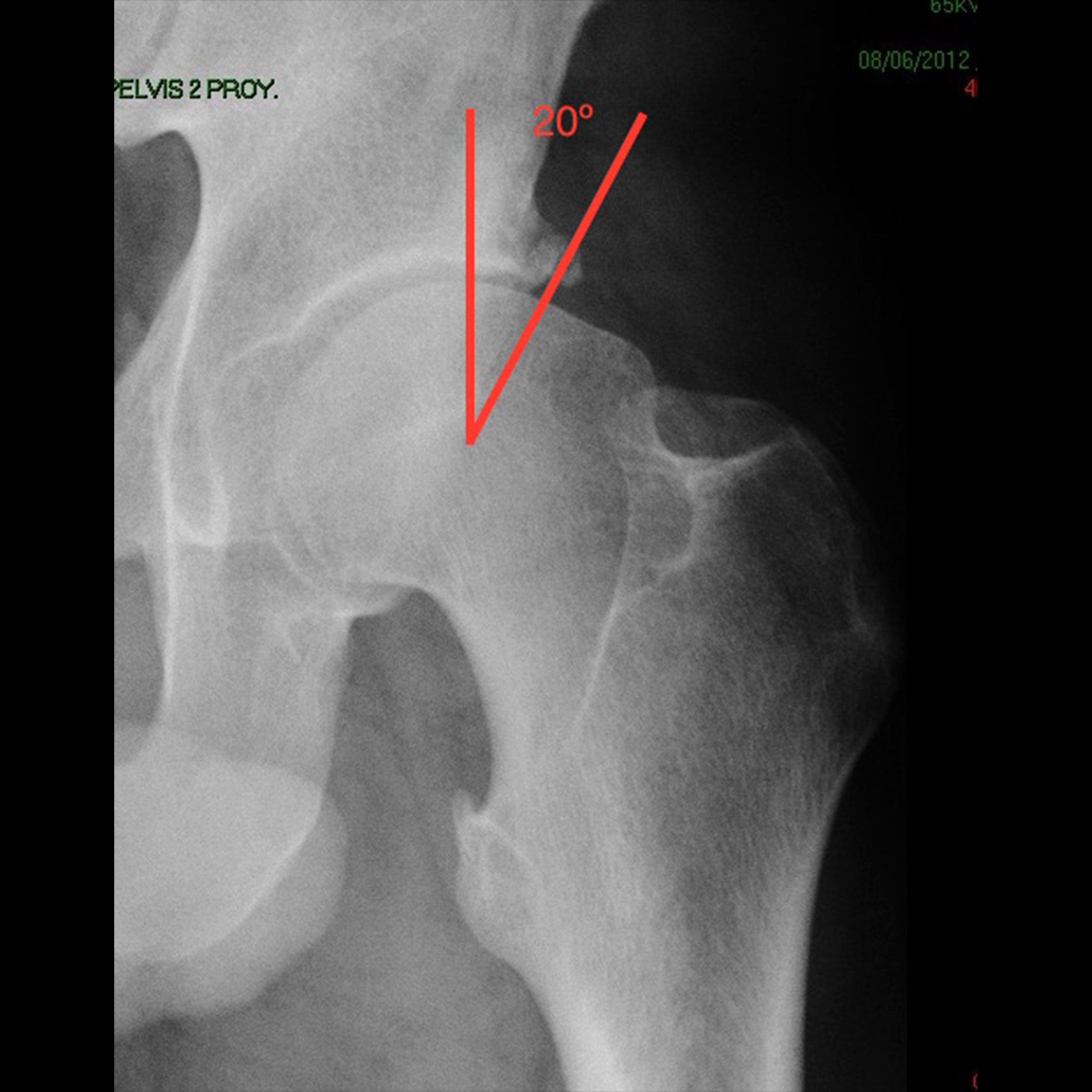 Radiografía con imagen de displasia de cadera por falta de cobertura acetabular