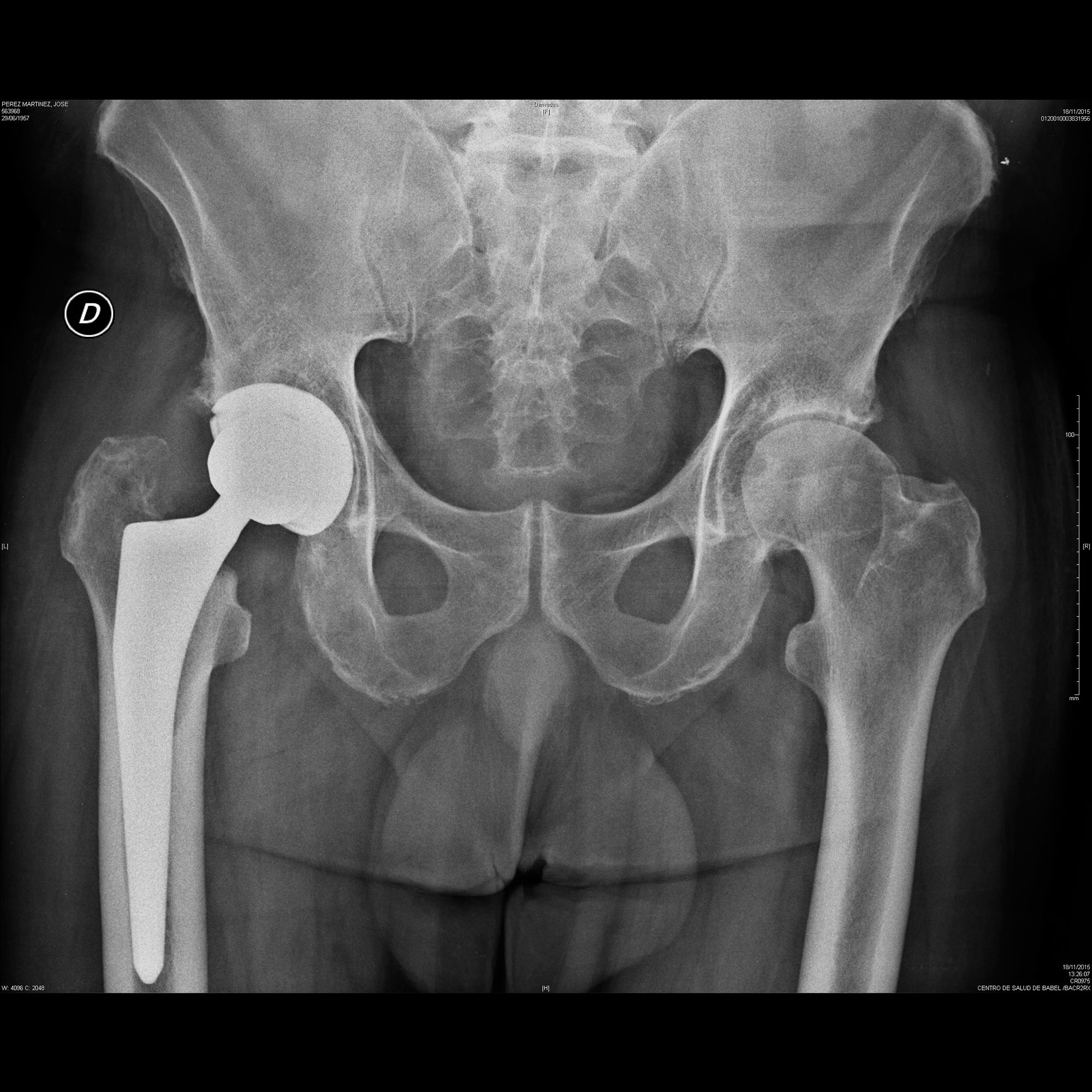Radiología de prótesis total de cadera