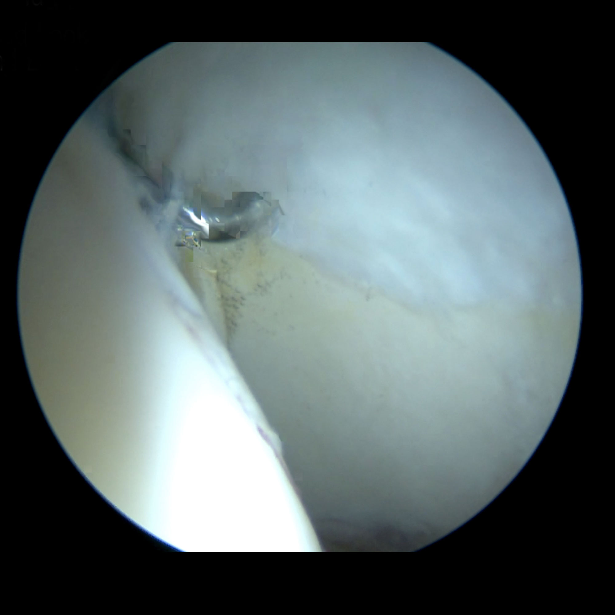 Imagen intraoperatoria por artroscopia del resultado de tratamiento de la lesión del cartílago acetabular con restitución de la zona de cartílago dañada