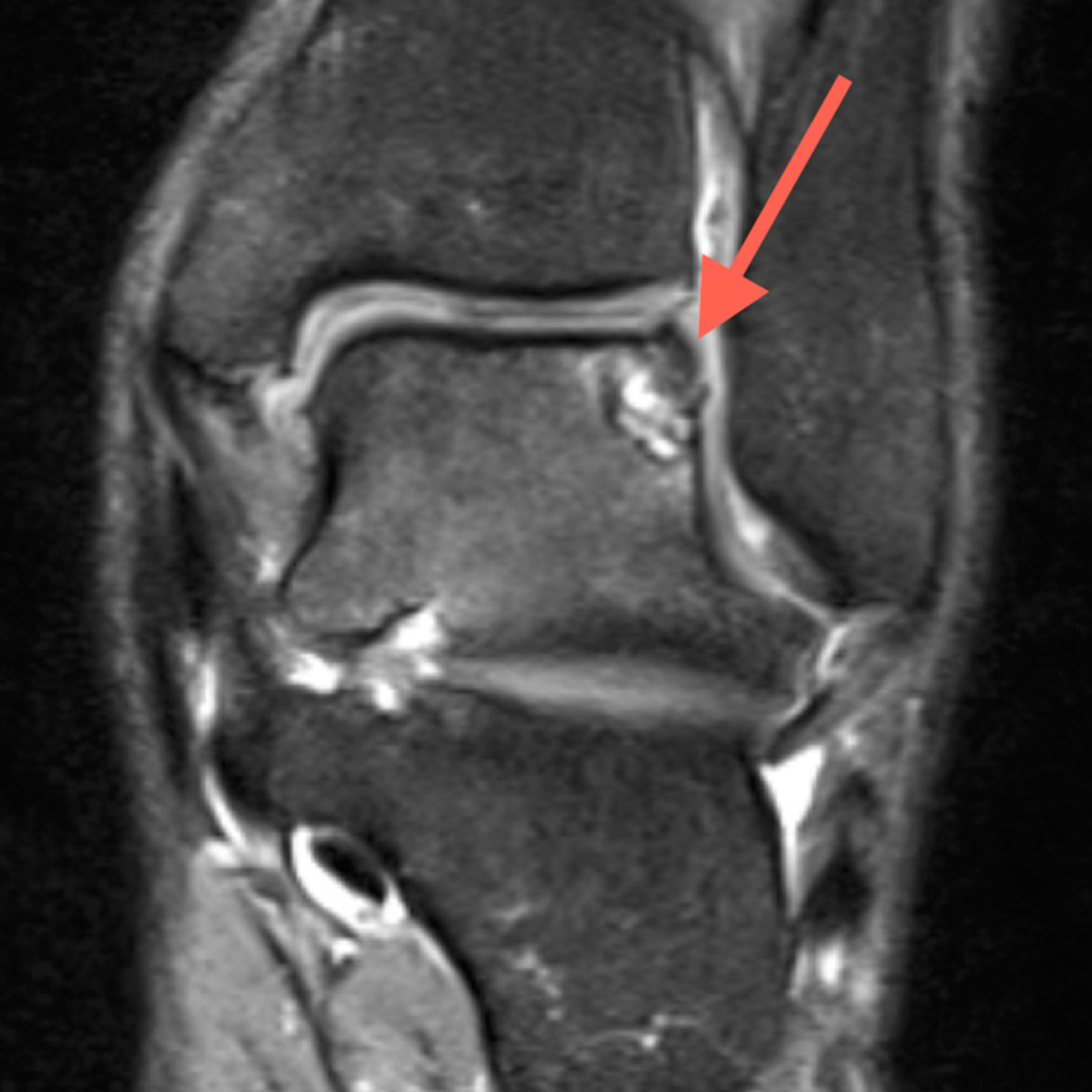  Imagen de RNM con lesión osteocondral de tobillo.
