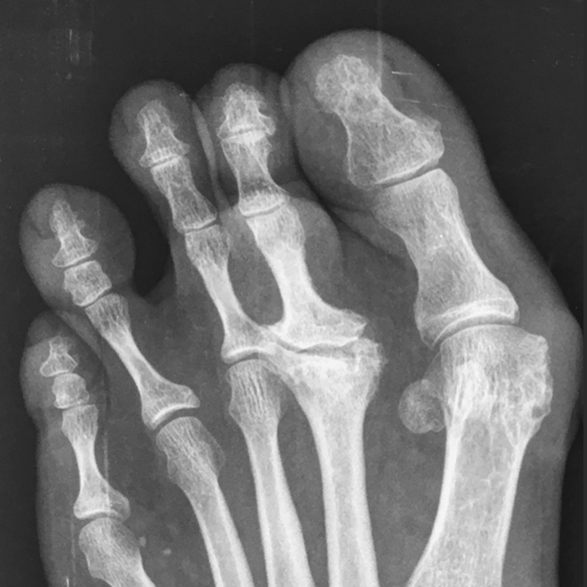 Radiología típica de enfermedad de Freiberg.